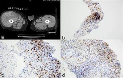 Case Report: Immune Checkpoint Inhibitor-Induced Exuberant Tumor Inflammation With Accelerated Clinical Deterioration in Metastatic Renal Cell Carcinoma